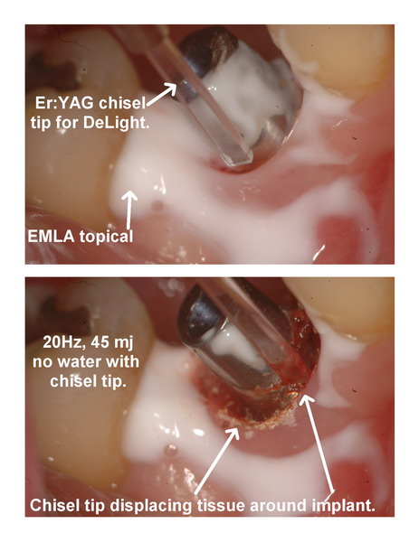 Implant seating pg 3 edited_resize.jpg